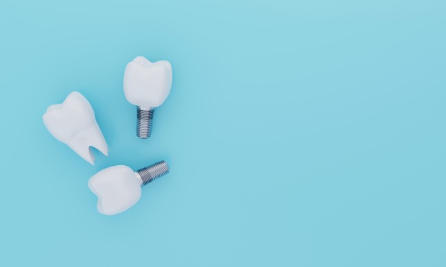 Implantes dentários: dúvidas comuns sobre os implantes para os dentes