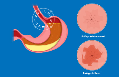Esófago de Barret