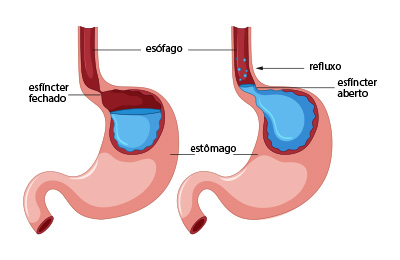 Refluxo gastroesofágico