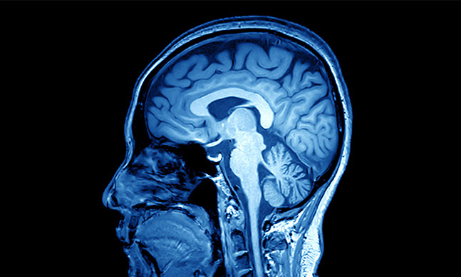 Aneurisma cerebral: o que é e quais os tratamentos existentes?