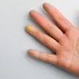 Fenómeno de Raynaud