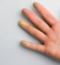 Fenómeno de Raynaud