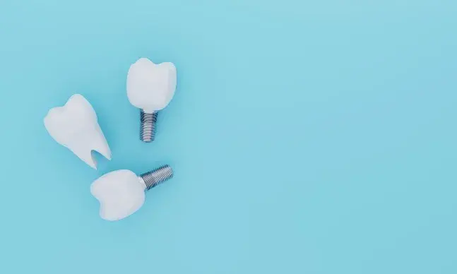 Implantes dentários: dúvidas comuns sobre os implantes para os dentes