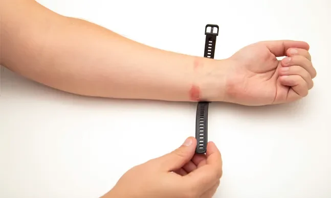 dermatite contato
