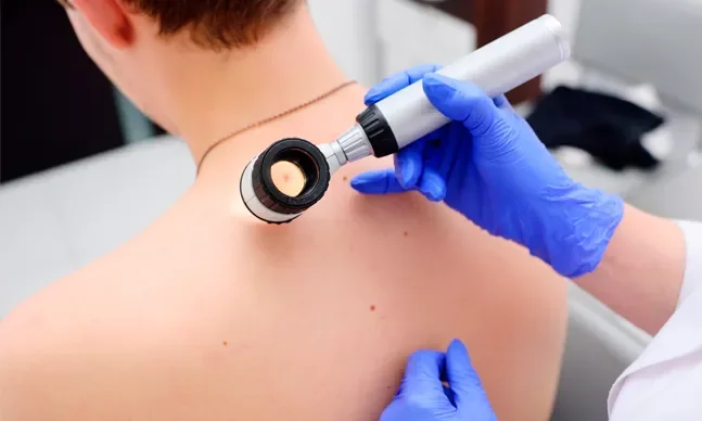 melanoma cancro da pele