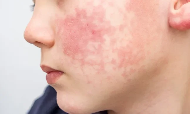 eritema infeccioso parvovirus