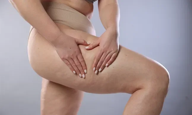 Lipedema