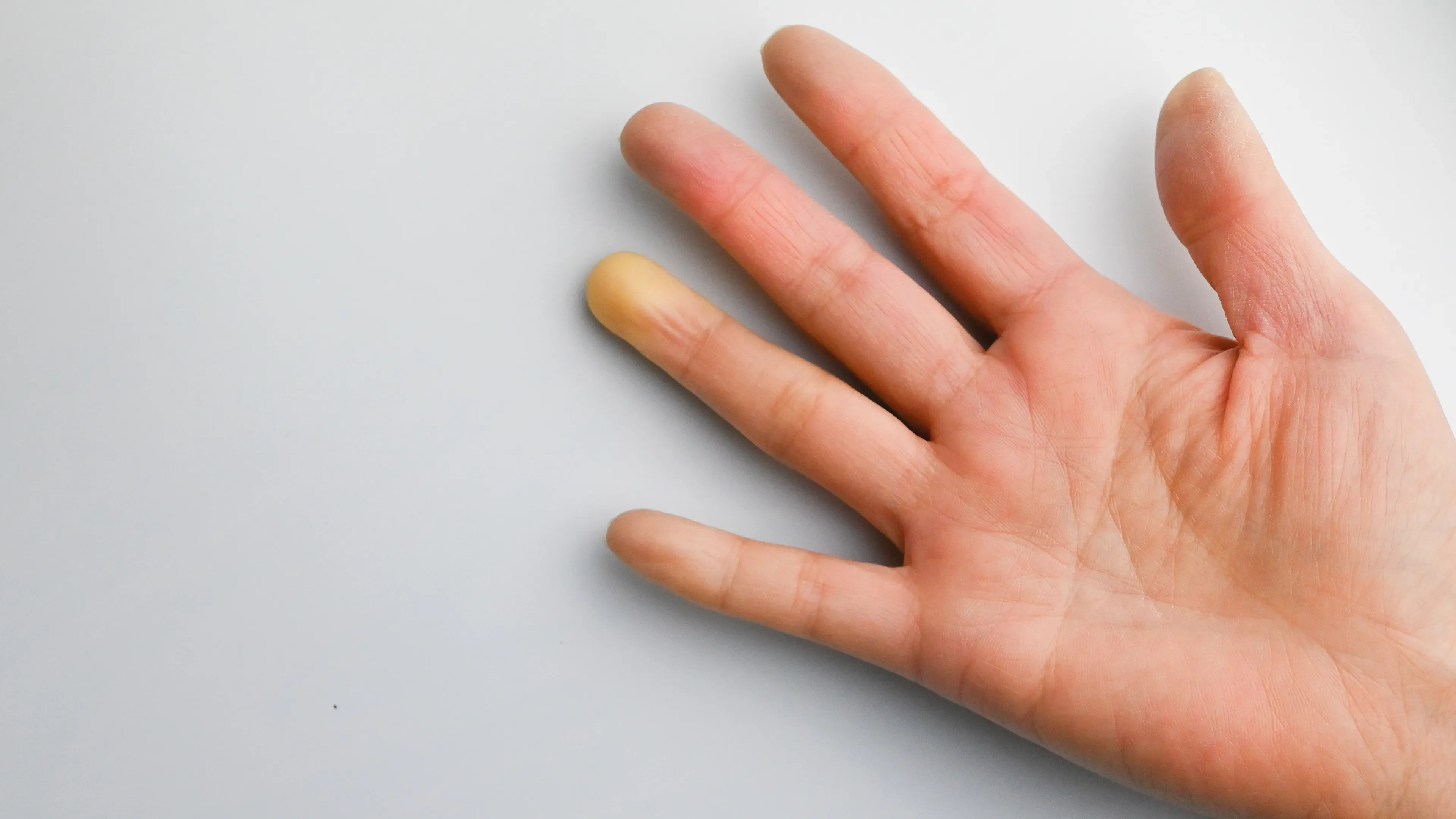 Fenómeno de Raynaud