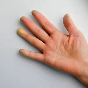 Fenómeno de Raynaud: o que é e como se previne?
