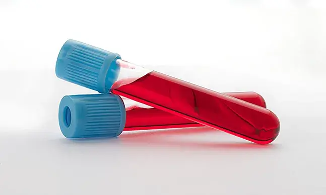 Chama-se anemia à redução do número de glóbulos vermelhos no sangue