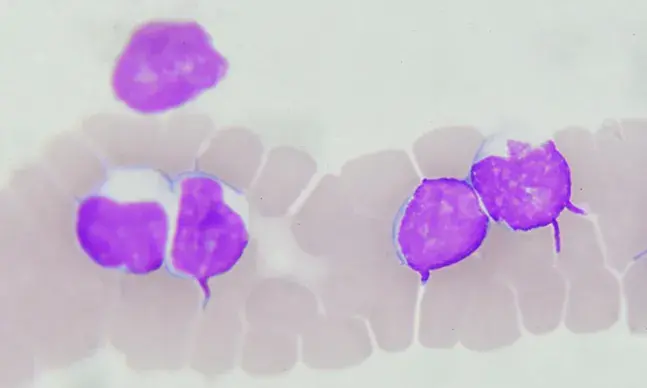 Os linfomas são dos tipos de cancro mais comuns em Portugal