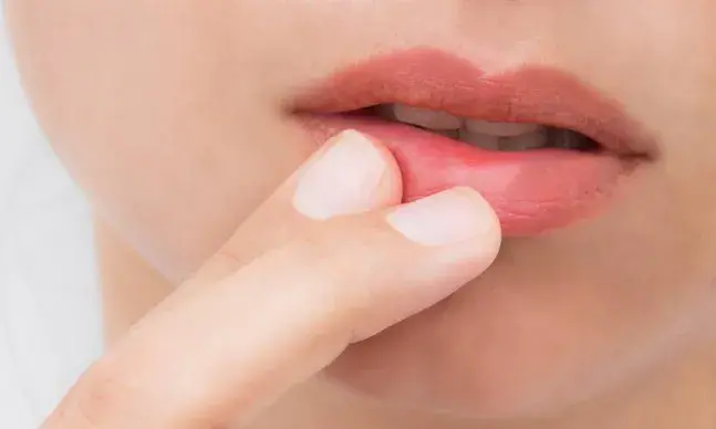 ​​​​​​​​​​​​​​Sabe o que é o herpes?O herpes é uma doença infecciosa provocada por um vírus que afeta geralmente os lábios e as mucosas - oral e genital , podendo ocorrer noutras regiões da pele ou mesmo nalguns órgãos internos.