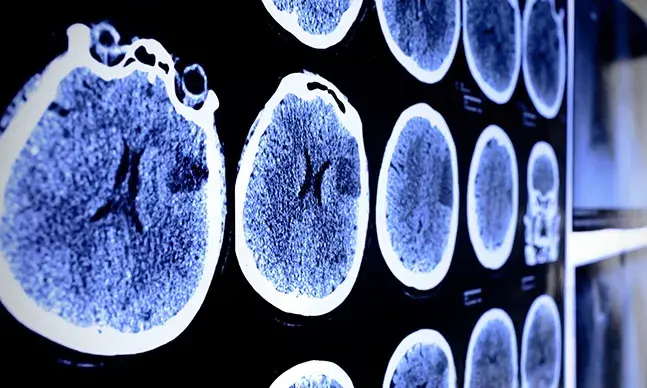 AVC: como reconhecer e atuar quando está em causa um Acidente Vascular Cerebral?