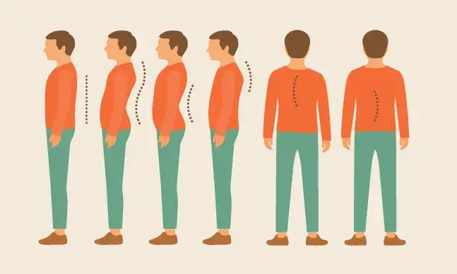 Escoliose: o que é e qual o tratamento?