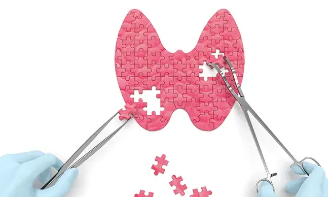 Hipertiroidismo: como funciona o tratamento com iodo-131