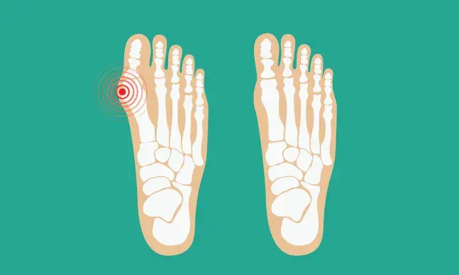 O que são os joanetes e como tratar?