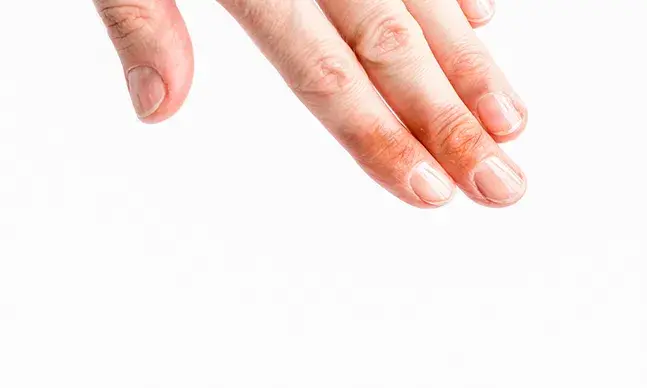 Deve-se colocar manteiga em caso de queimadura?