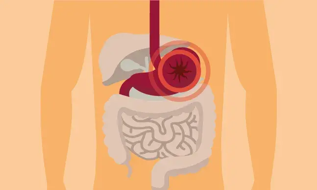 Úlcera péptica: o que é e como se trata