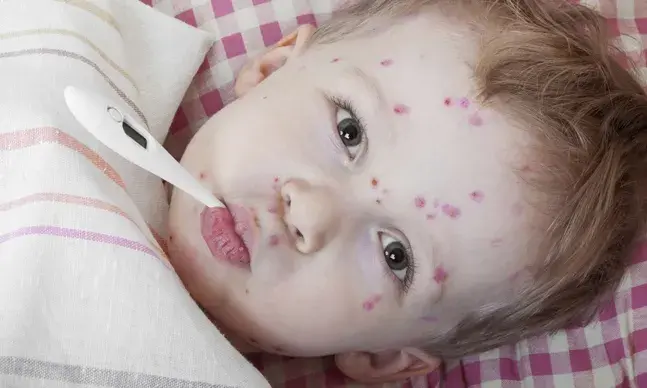 Muitas doenças infectocontagiosas da infância, como a varicela e o sarampo são de caráter benigno, mas merecem atenção dado o risco de contágio.