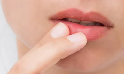Sabe o que é o herpes?O herpes é uma doença infecciosa provocada por um vírus que afeta geralmente os lábios e as mucosas - oral e genital , podendo ocorrer noutras regiões da pele ou mesmo nalguns órgãos internos. Sabe o que é o herpes?O herpes é uma doença infecciosa provocada por um vírus que afeta geralmente os lábios e as mucosas - oral e genital , podendo ocorrer noutras regiões da pele ou mesmo nalguns órgãos internos.