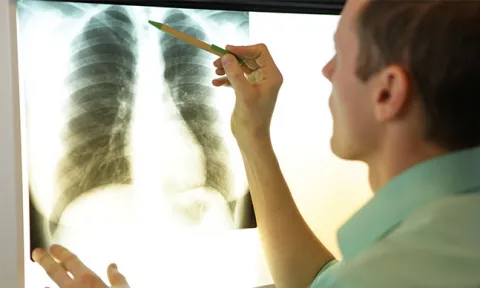 Os diferentes tipos de cancro do pulmão e os tratamentos disponíveis Os diferentes tipos de cancro do pulmão e os tratamentos disponíveis