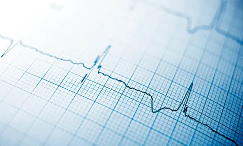 Saiba o que é o eletrocardiograma, para que serve e como é feito Saiba o que é o eletrocardiograma, para que serve e como é feito