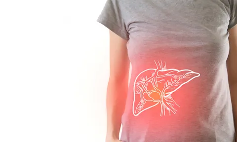 Fígado gordo: o que é a esteatose hepática? Fígado gordo: o que é a esteatose hepática?