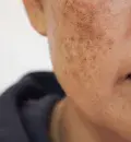 Melasma: quais os tratamentos para as manchas na pele?