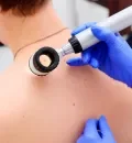 melanoma cancro da pele