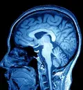 Aneurisma cerebral: o que é e quais os tratamentos existentes?