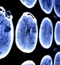 AVC: como reconhecer e atuar quando está em causa um Acidente Vascular Cerebral?