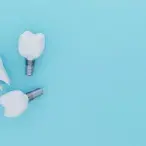 Implantes dentários: dúvidas comuns sobre os implantes para os dentes