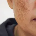 Melasma: quais os tratamentos para as manchas na pele?