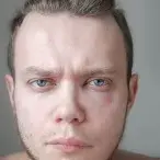 O que é o angioedema e quais os tratamentos