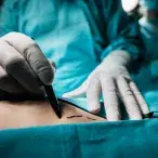 lipoaspiração