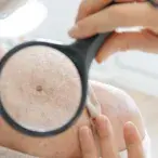 Cancro Cutaneo