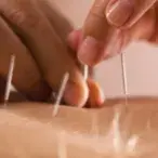 acupuntura
