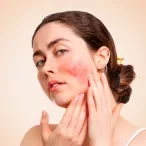 rosacea