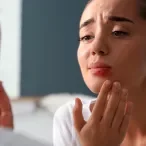 herpes labial