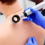 melanoma cancro da pele