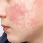 eritema infeccioso parvovirus