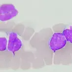 Os linfomas são dos tipos de cancro mais comuns em Portugal