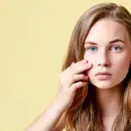 Acne na adolescência: o que deve saber