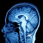 Aneurisma cerebral: o que é e quais os tratamentos existentes?