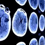 AVC: como reconhecer e atuar quando está em causa um Acidente Vascular Cerebral?