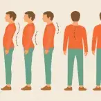 Escoliose: o que é e qual o tratamento?