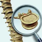 Hérnia discal lombar: cirurgia pioneira à coluna