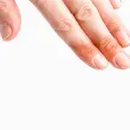 Deve-se colocar manteiga em caso de queimadura?