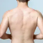 Sinus pilonidalis: qual o tratamento para o quisto pilonidal