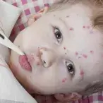 Muitas doenças infectocontagiosas da infância, como a varicela e o sarampo são de caráter benigno, mas merecem atenção dado o risco de contágio.